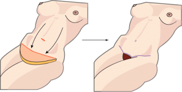 buikwandcorrectie of abdominoplastie